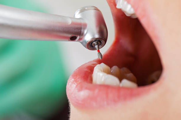 Best Broken or Chipped Tooth Repair in Tariffville, CT
